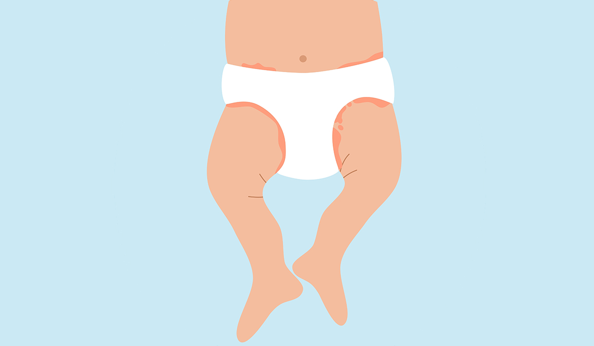 Diaper Rash: What Is, Types, Risk Factors, Symptoms, and Treatment