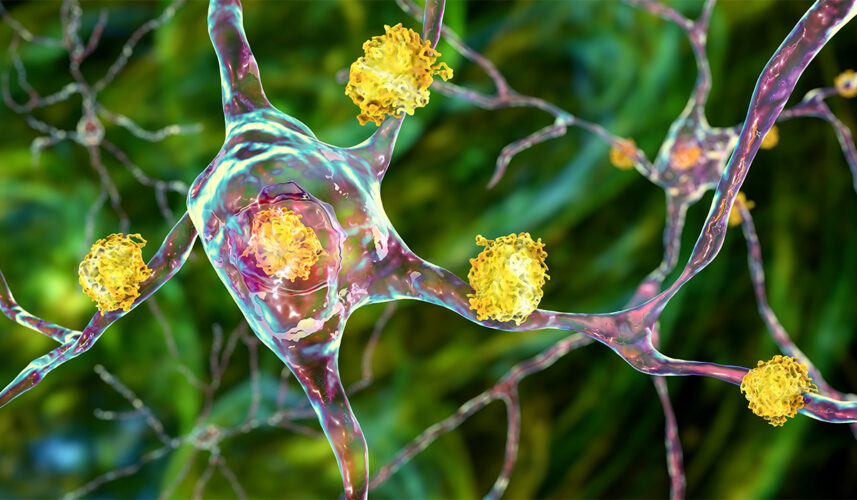 Huntington's Disease: What Is, Causes, Symptoms, Treatment, and Prognosis