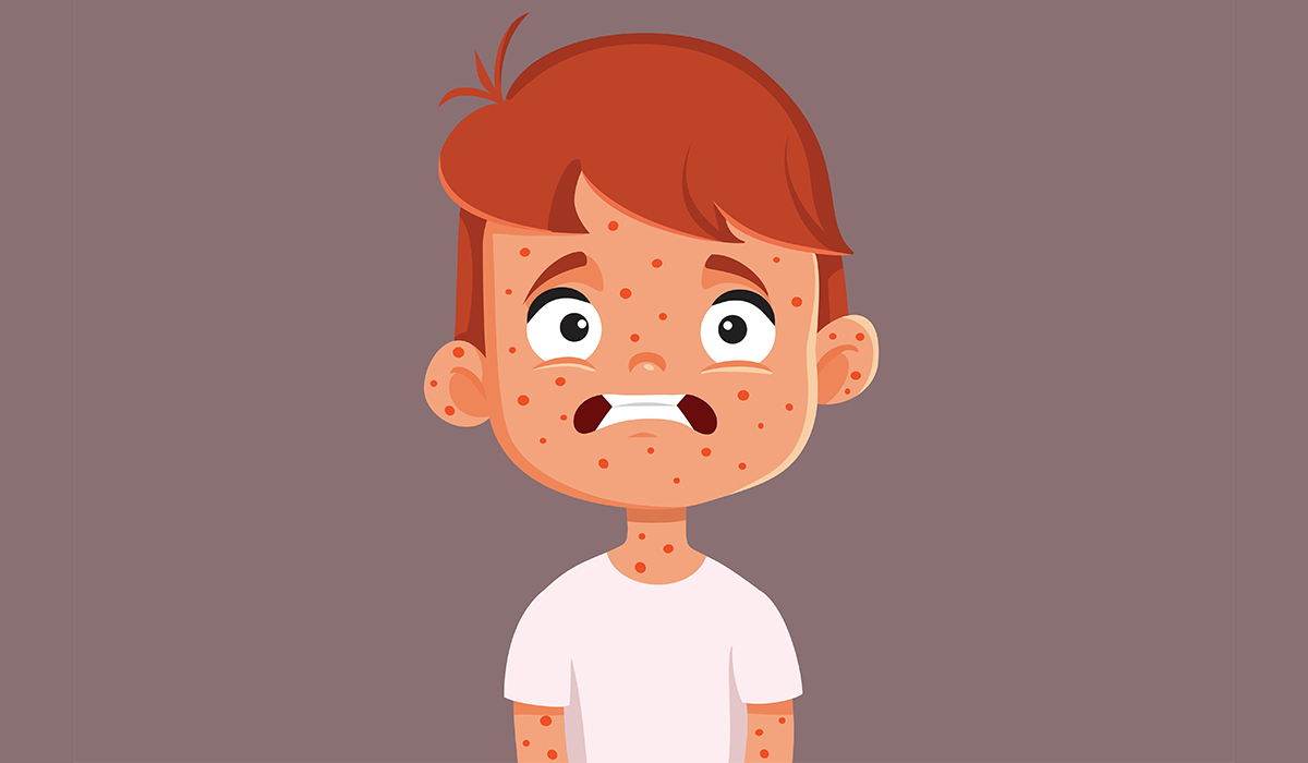 Measles: What Is, Types, Causes, Symptoms, and Treatment