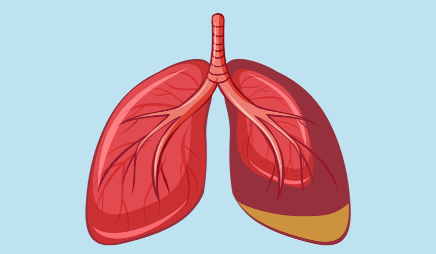 Mesothelioma: What Is, Types, Causes, Diagnosis, and Treatment