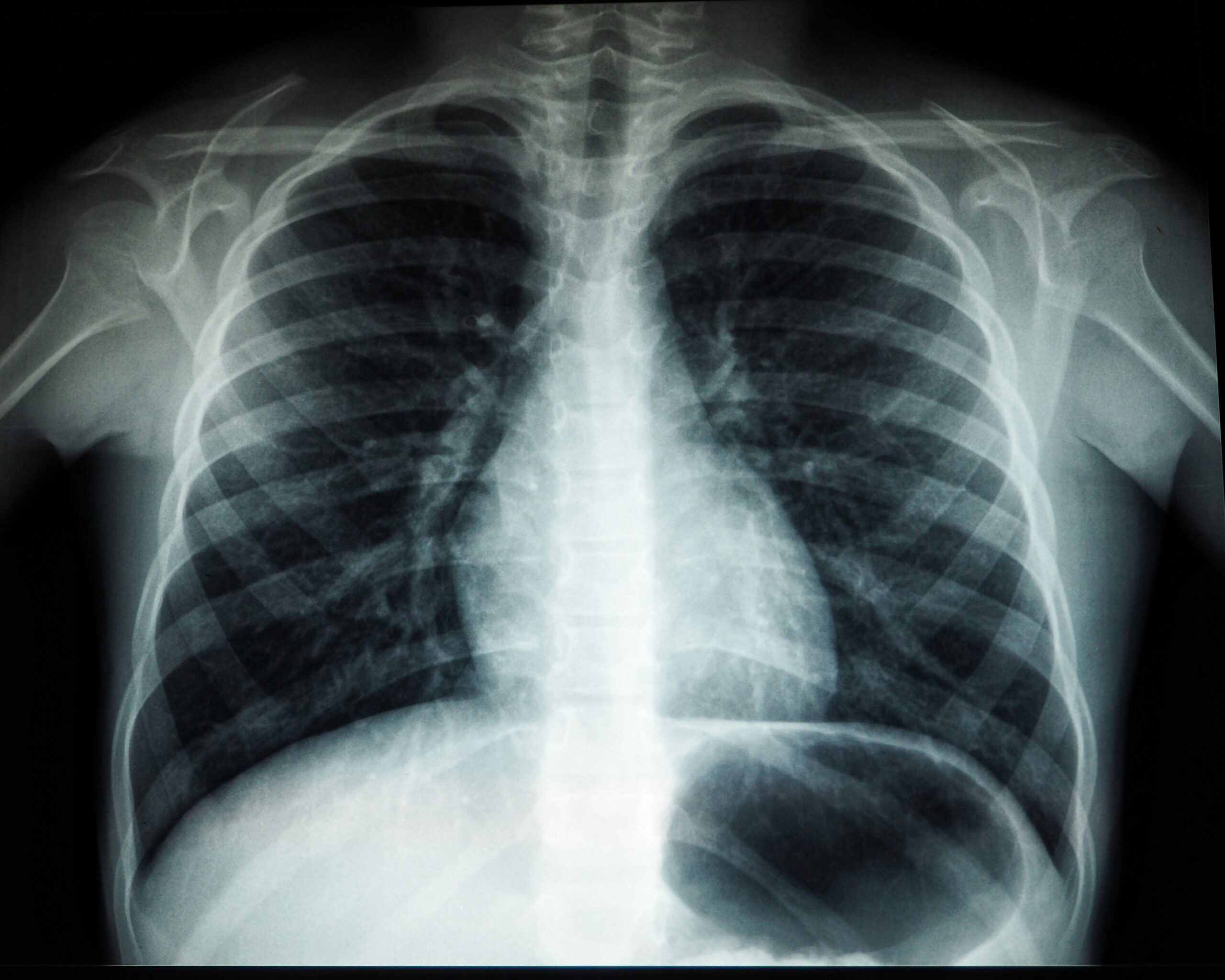 Mesothelioma: What Is, Types, Causes, Diagnosis, and Treatment
