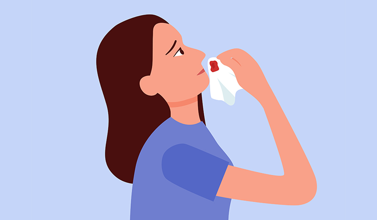 Nosebleed: What Is, Causes, Symptoms, and Treatment