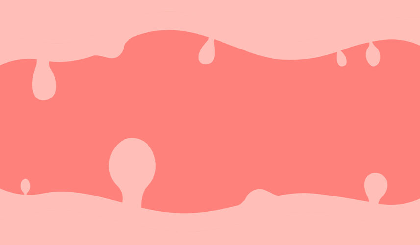 Polyp: What Is, Types, Causes, Diagnosis, and Treatment