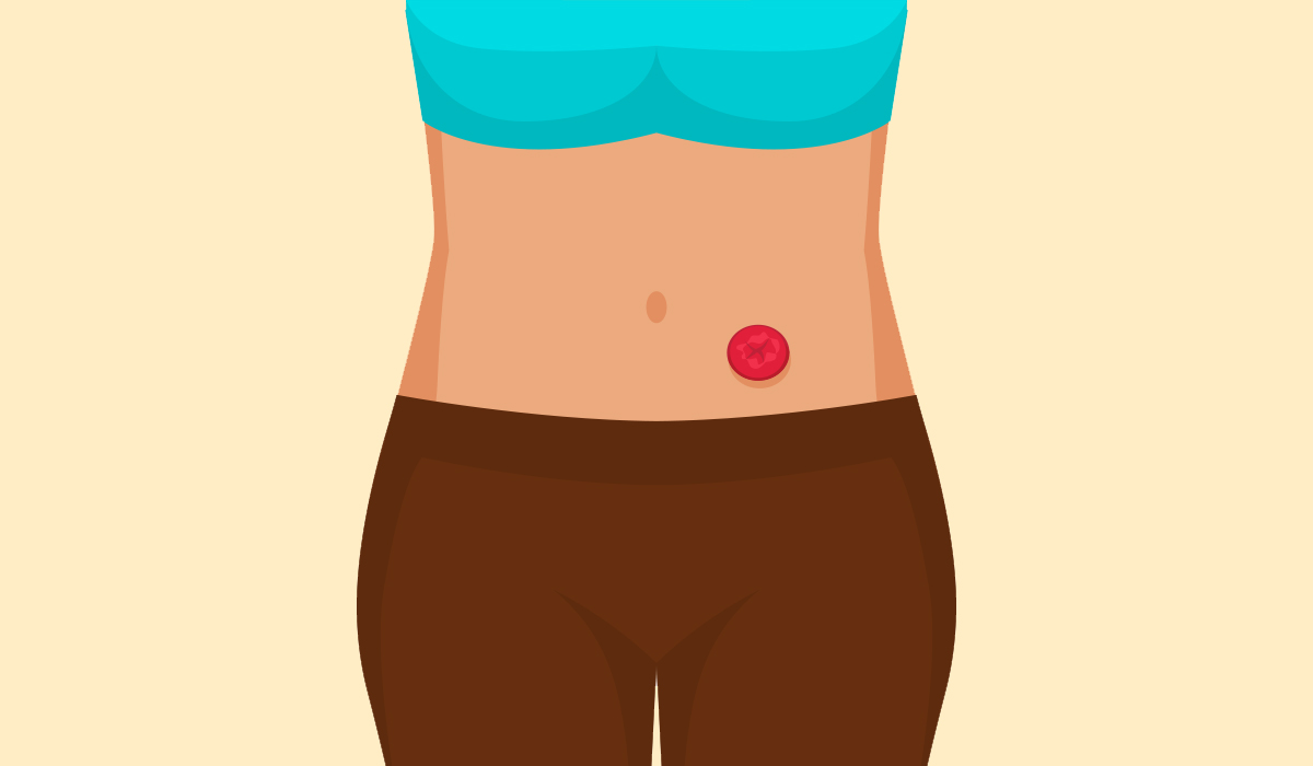 Stoma: What Is, Types, Causes, Procedure, Function, and Care