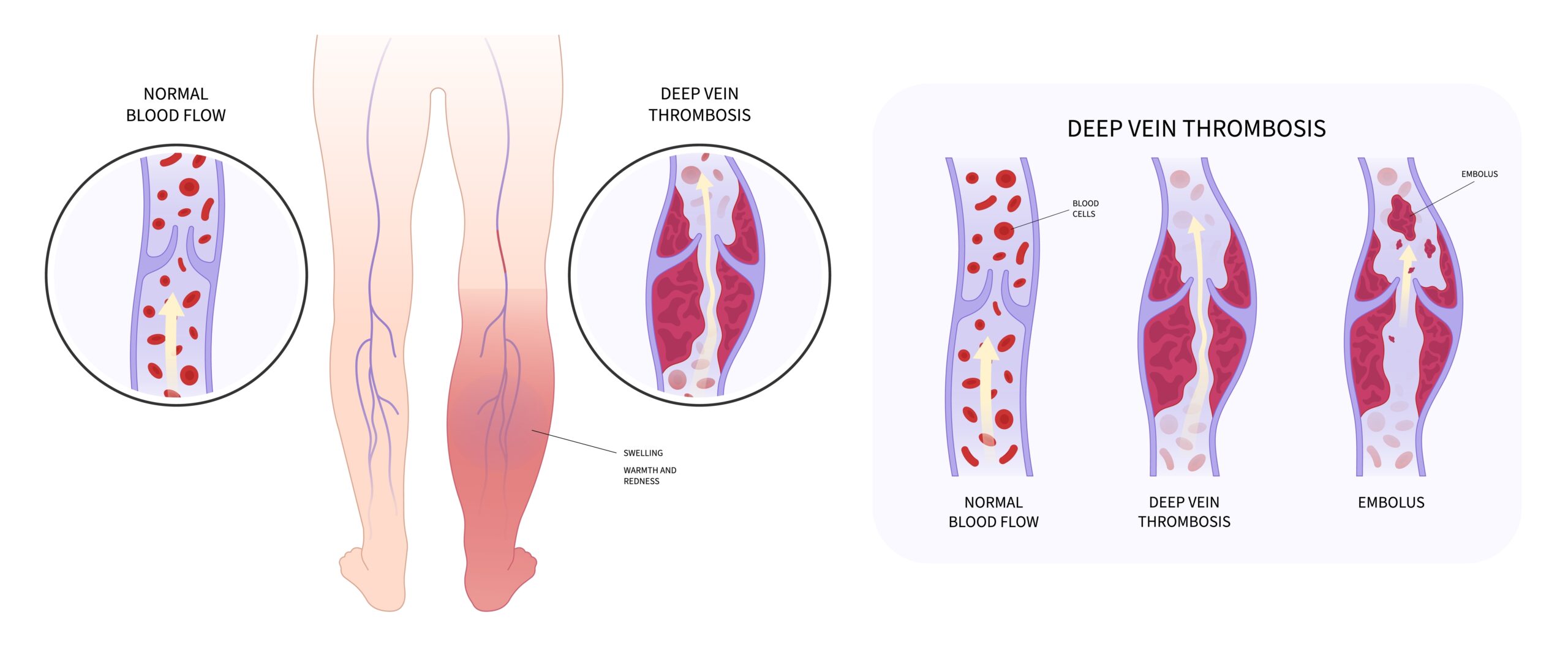 Thrombosis: What Is, Causes, Symptoms, Diagnosis, and Treatment