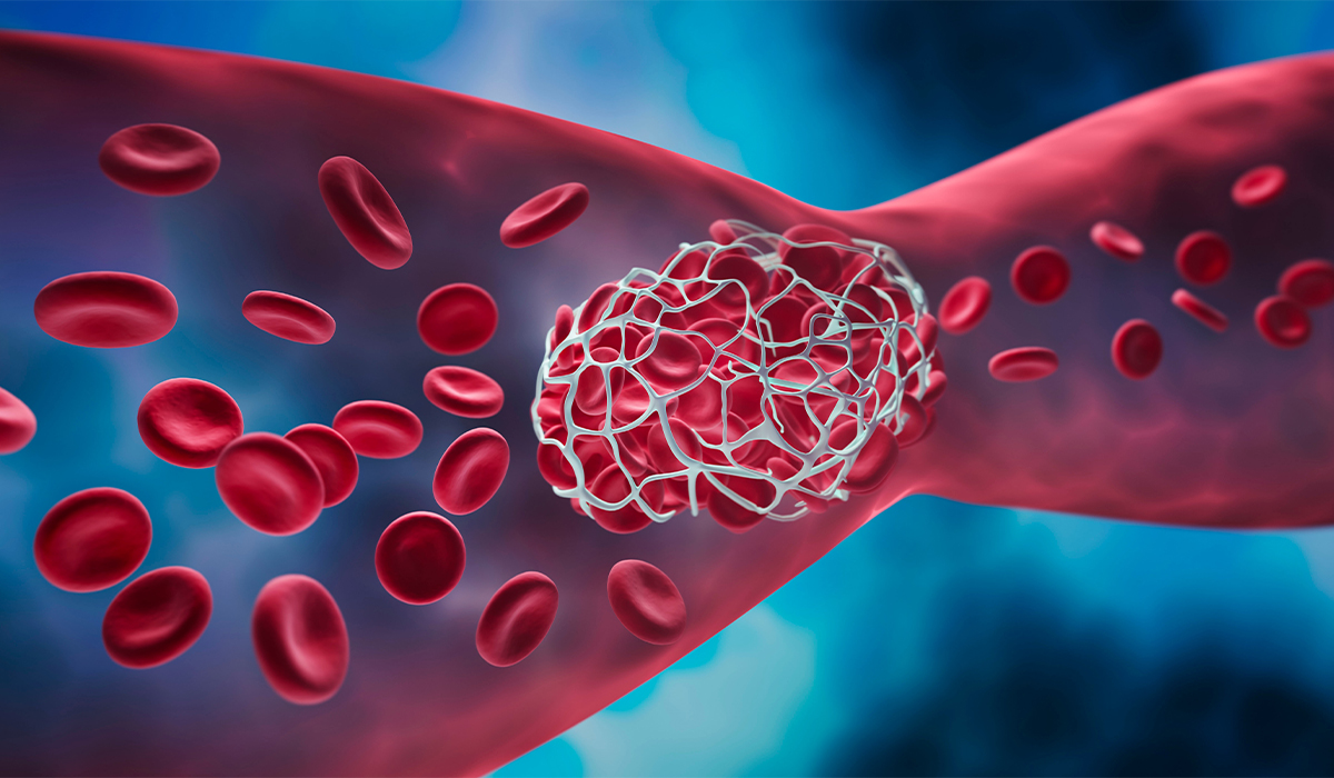 Thrombosis: What Is, Causes, Symptoms, Diagnosis, Treatment, and Complications