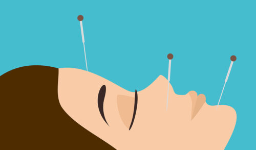 Acupuncture: What Is, Mechanism of Action, and Risks