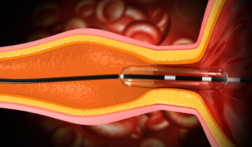Angioplasty: What is, Types, Who Needs It, and Recovery Time