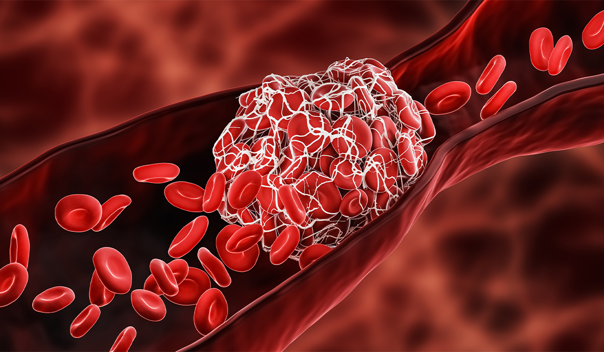 Blood Clot: What Is, Conditions, and Prevention