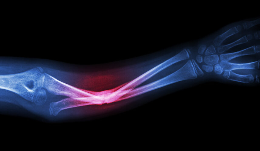 Bone Fracture: What Is, Causes, Diagnosis, Treatment, and Prognosis