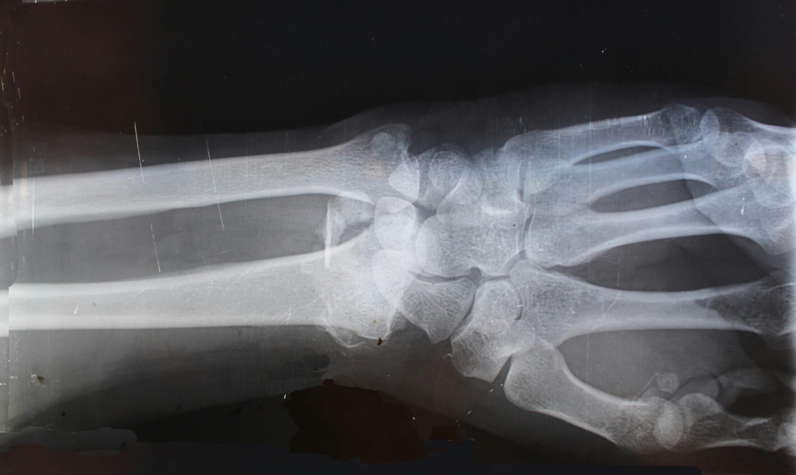 Bone Fracture: What Is, Causes, Diagnosis, Treatment, and Prognosis