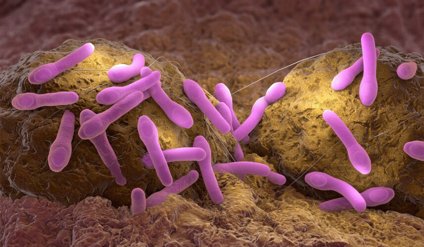 Botulism: What Is, Causes, Symptoms, Diagnosis, Treatment, and Prevention