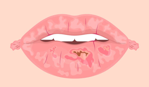 Chapped Lips: What Are, Causes, Home Remedies, and Medical Treatment