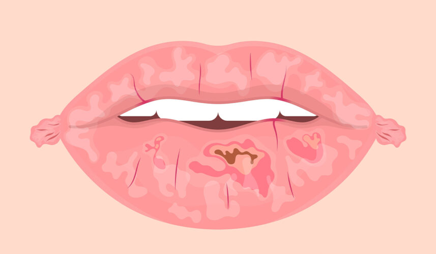 Chapped Lips: What Are, Causes, and Medical Treatment