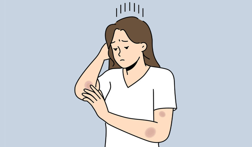 Hematoma: What Is, Causes, Types, Diagnosis, and Treatment