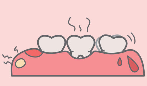 Periodontal Disease: What Is, Causes, Diagnosis, and Treatment