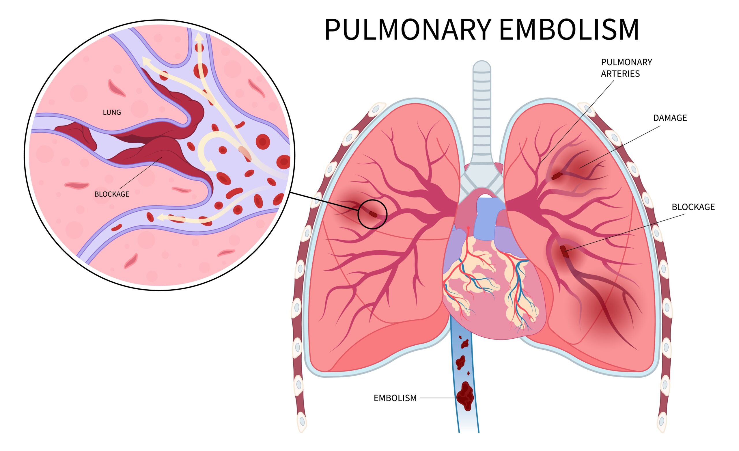 Pulmonary Embolism: What Is, Causes, Symptoms, and Diagnosis