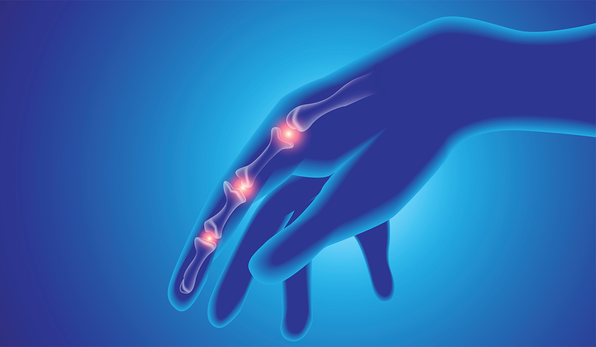 Rheumatoid Arthritis: What Is, Causes, Diagnosis, and Treatment
