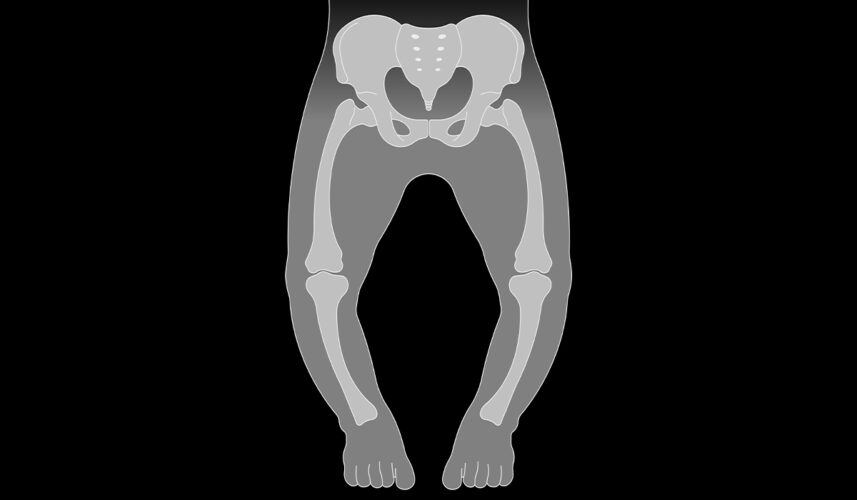 Rickets: What Are, Causes, Symptoms, and Treatment