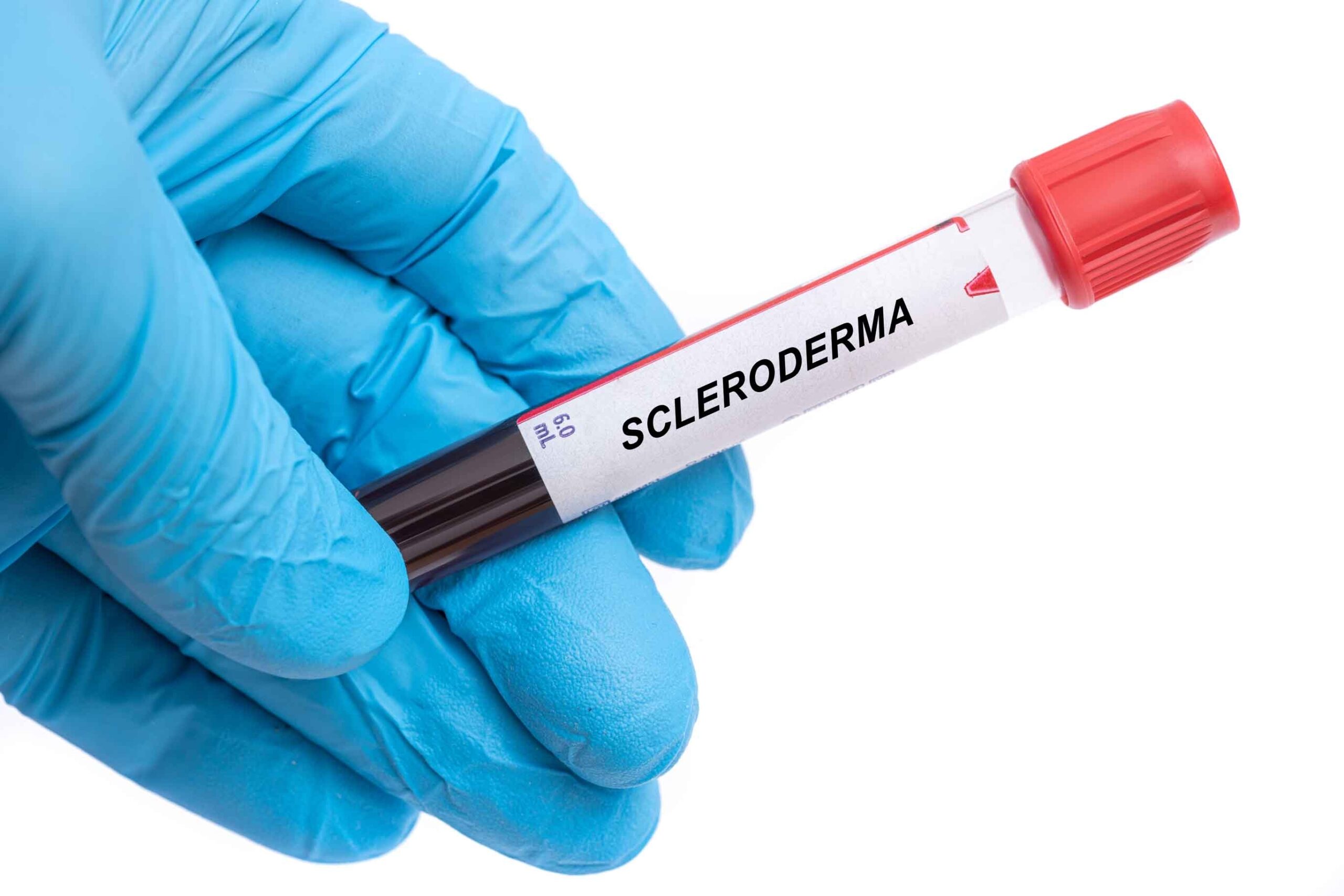 Scleroderma: What Is, Types, Causes, Symptoms, and Diagnosis