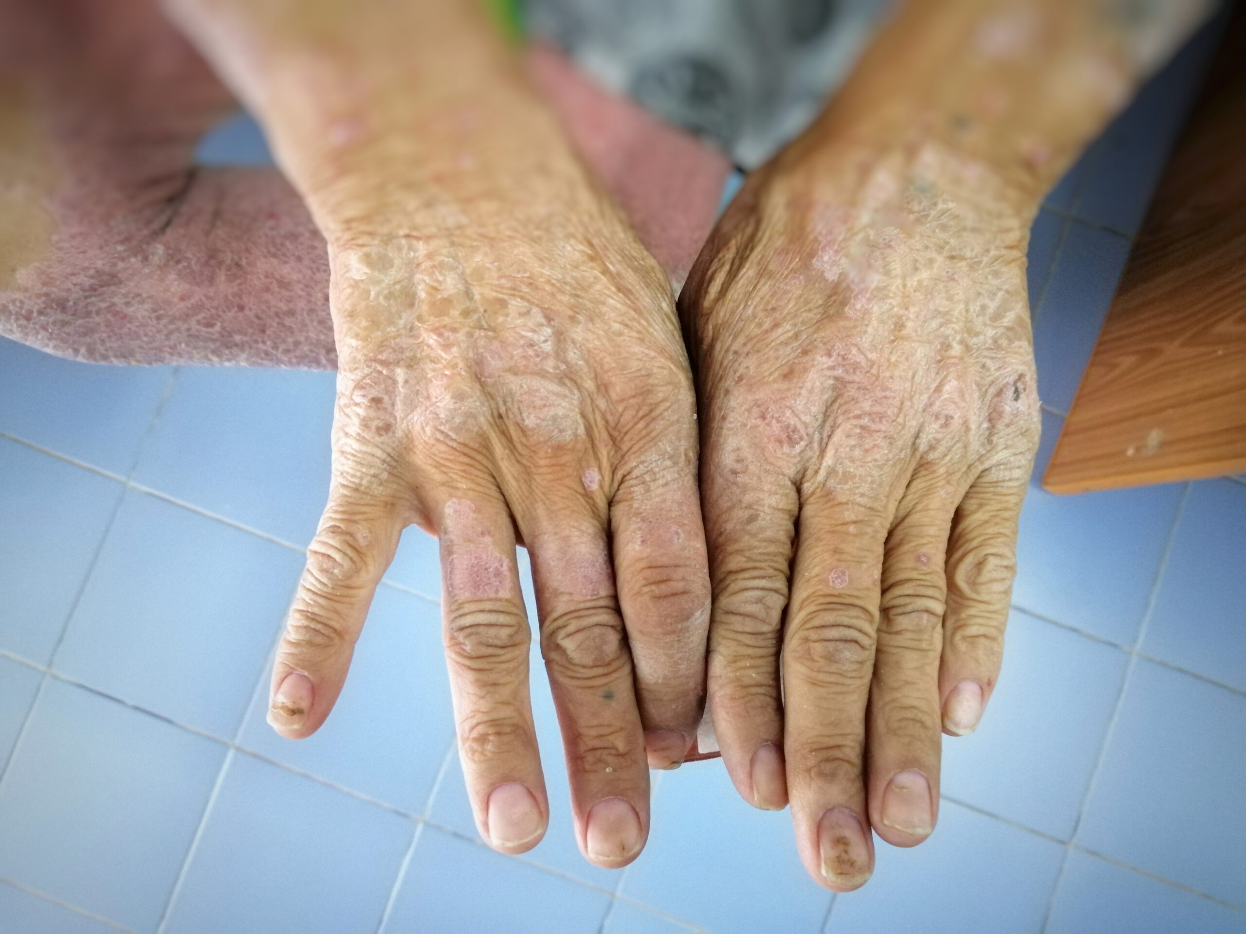 Scleroderma: What Is, Types, Causes, Symptoms, and Diagnosis