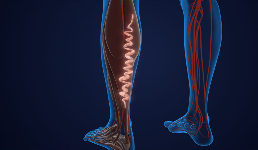 Varicose Veins: What Are, Causes, Symptoms, Treatment, and Prevention