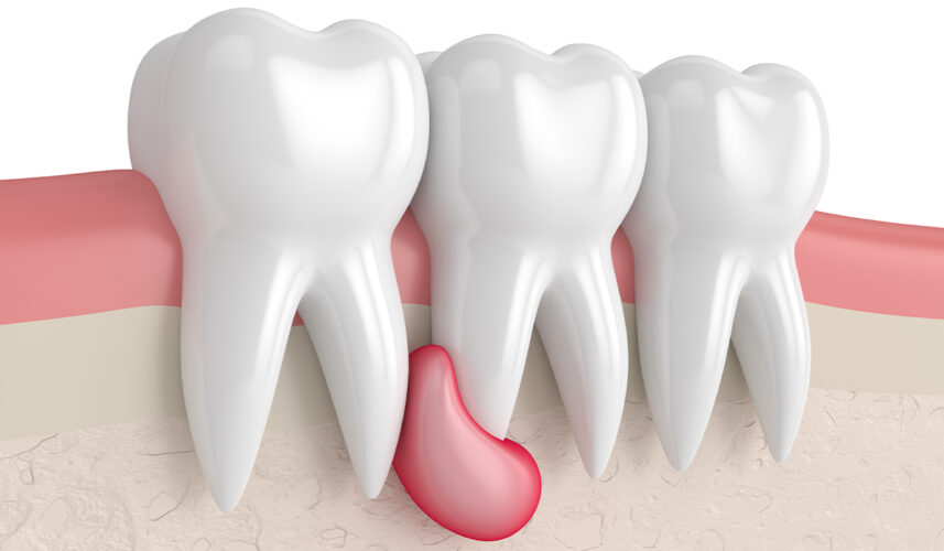 Abscess Tooth: What Is, Causes, Symptoms, and Treatment