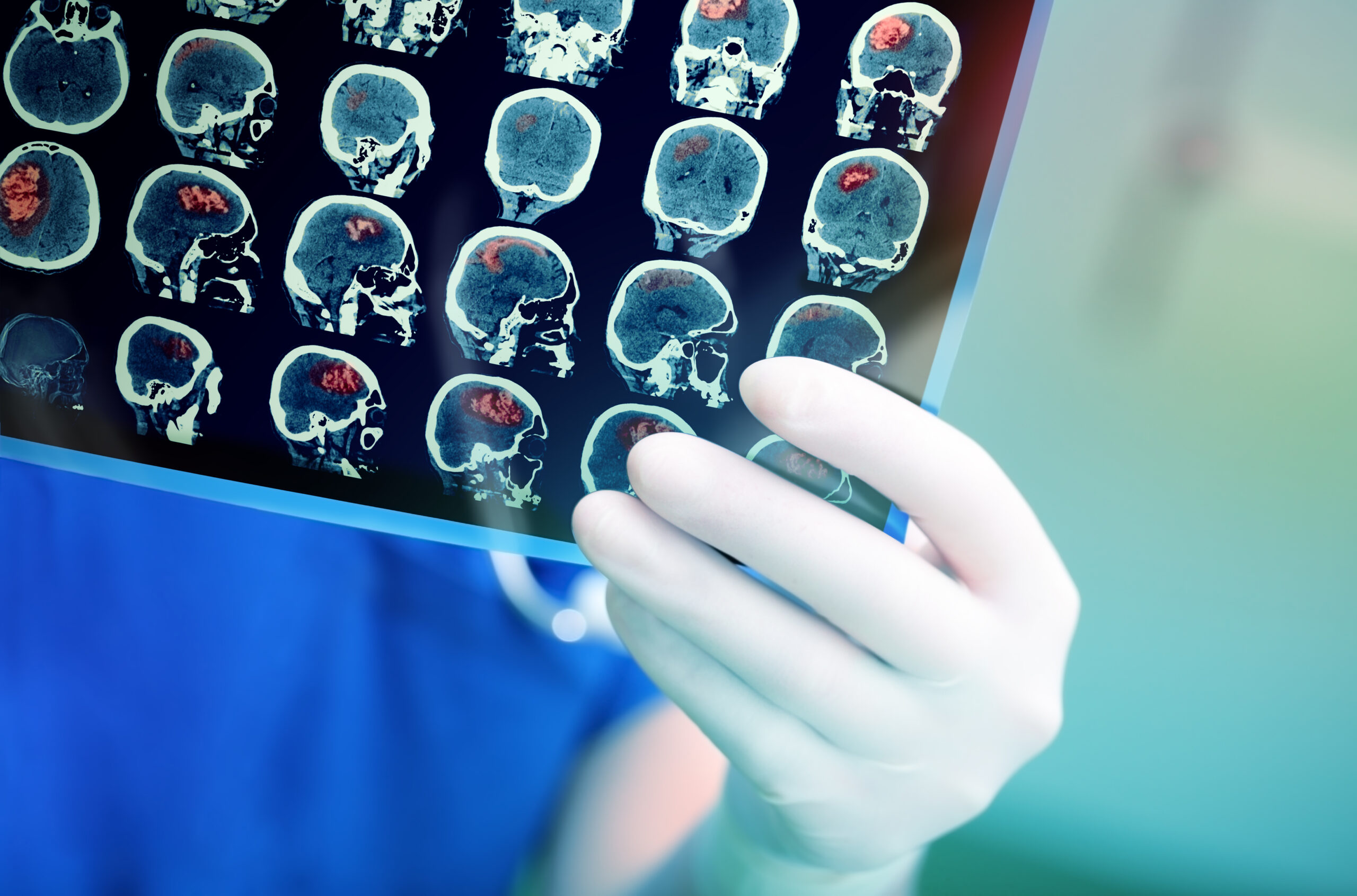 Brain Tumor: What Is, Causes, Symptoms, Diagnosis, and Treatment