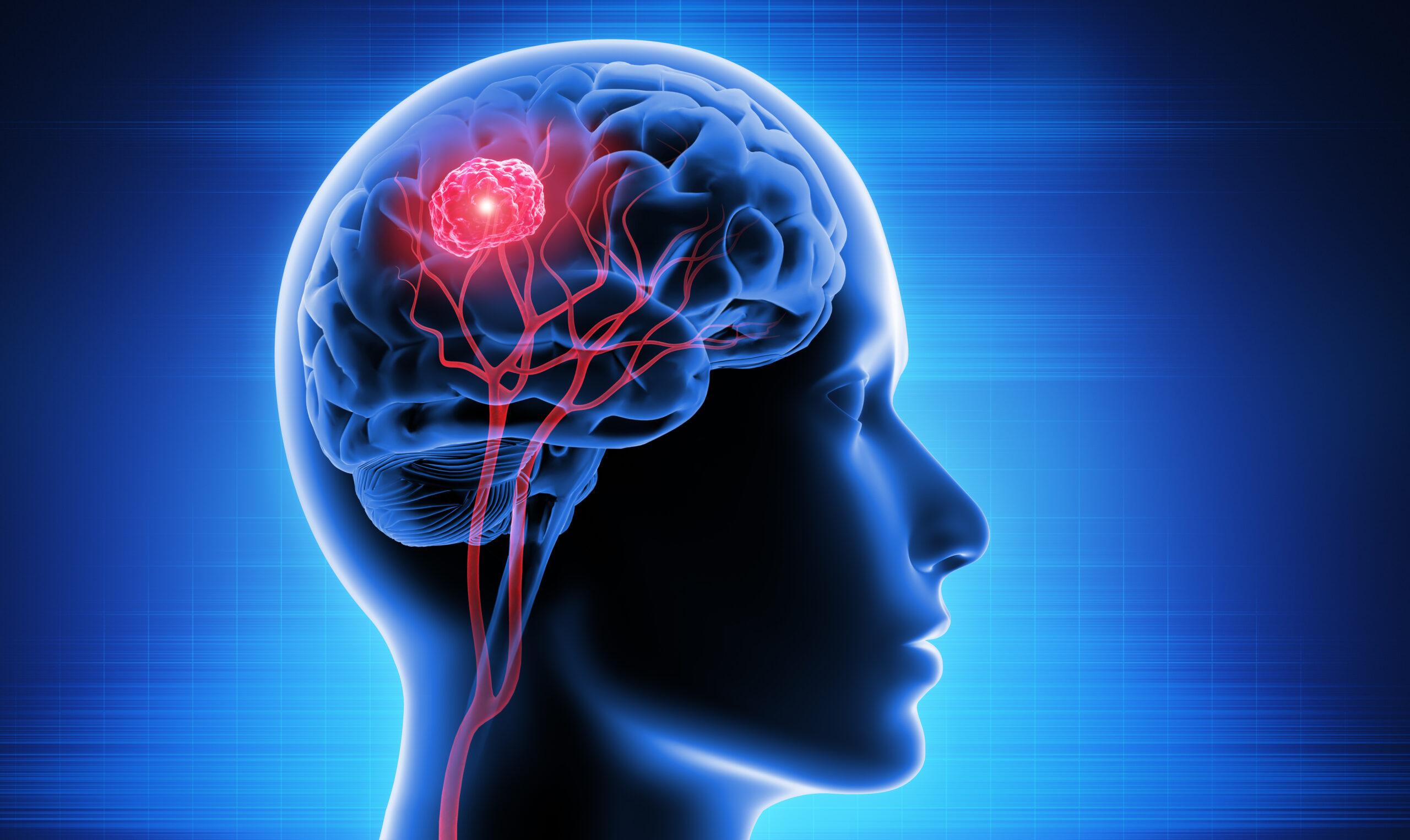 Brain Tumor: What Is, Causes, Symptoms, Diagnosis, and Treatment