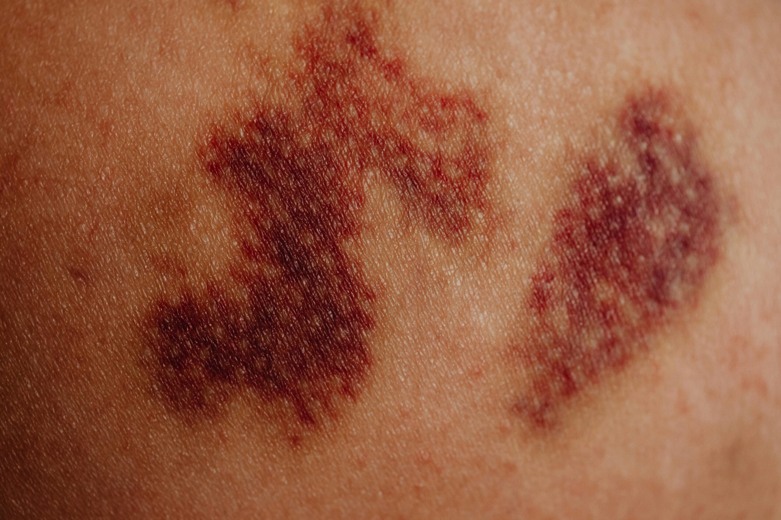 Bruise: What Is, Causes, Treatment, and When To See A Doctor