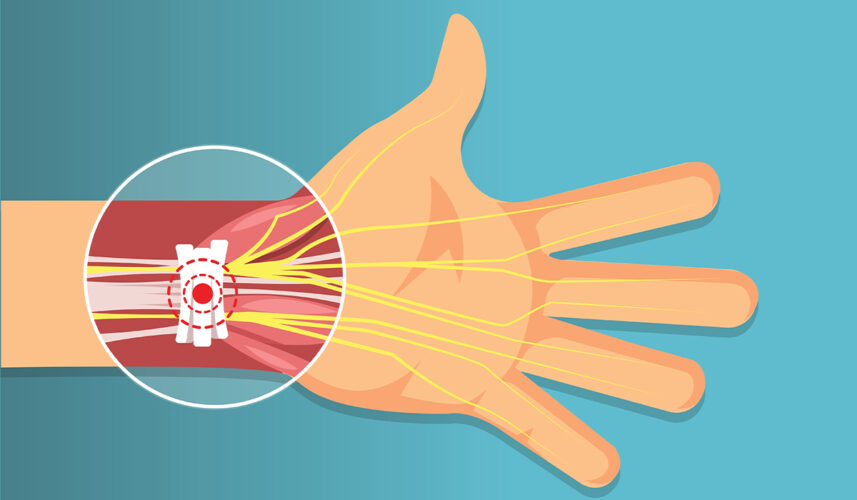 Carpal Tunnel: What Is, Causes, Treatment, and Prognosis