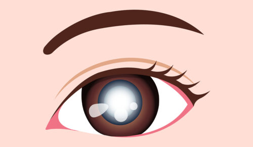 Cataract: What Is, Causes, Types, Symptoms, Diagnosis, and Treatment