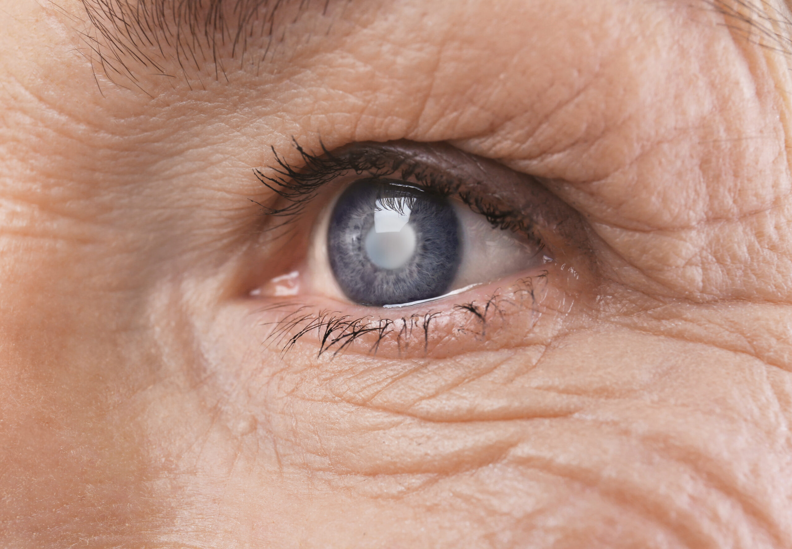 Cataract: What Is, Causes, Types, Symptoms, Diagnosis, and Treatment