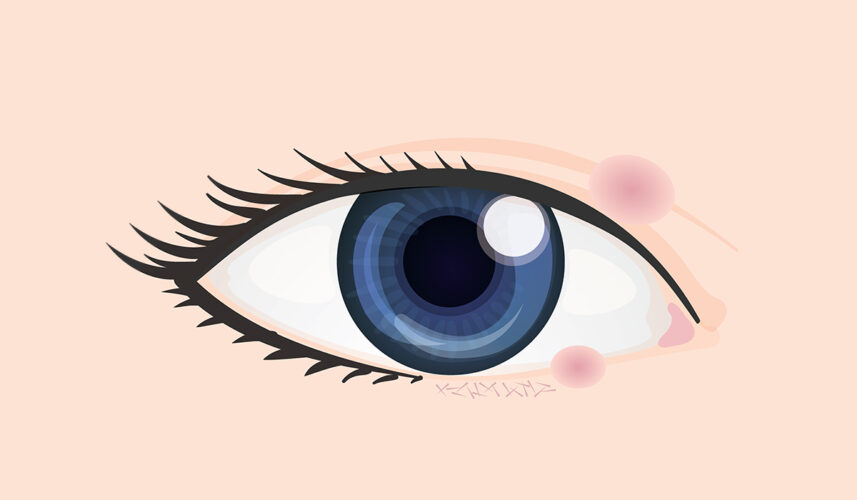 Chalazion: What Is, Causes, Symptoms, and Diagnosis