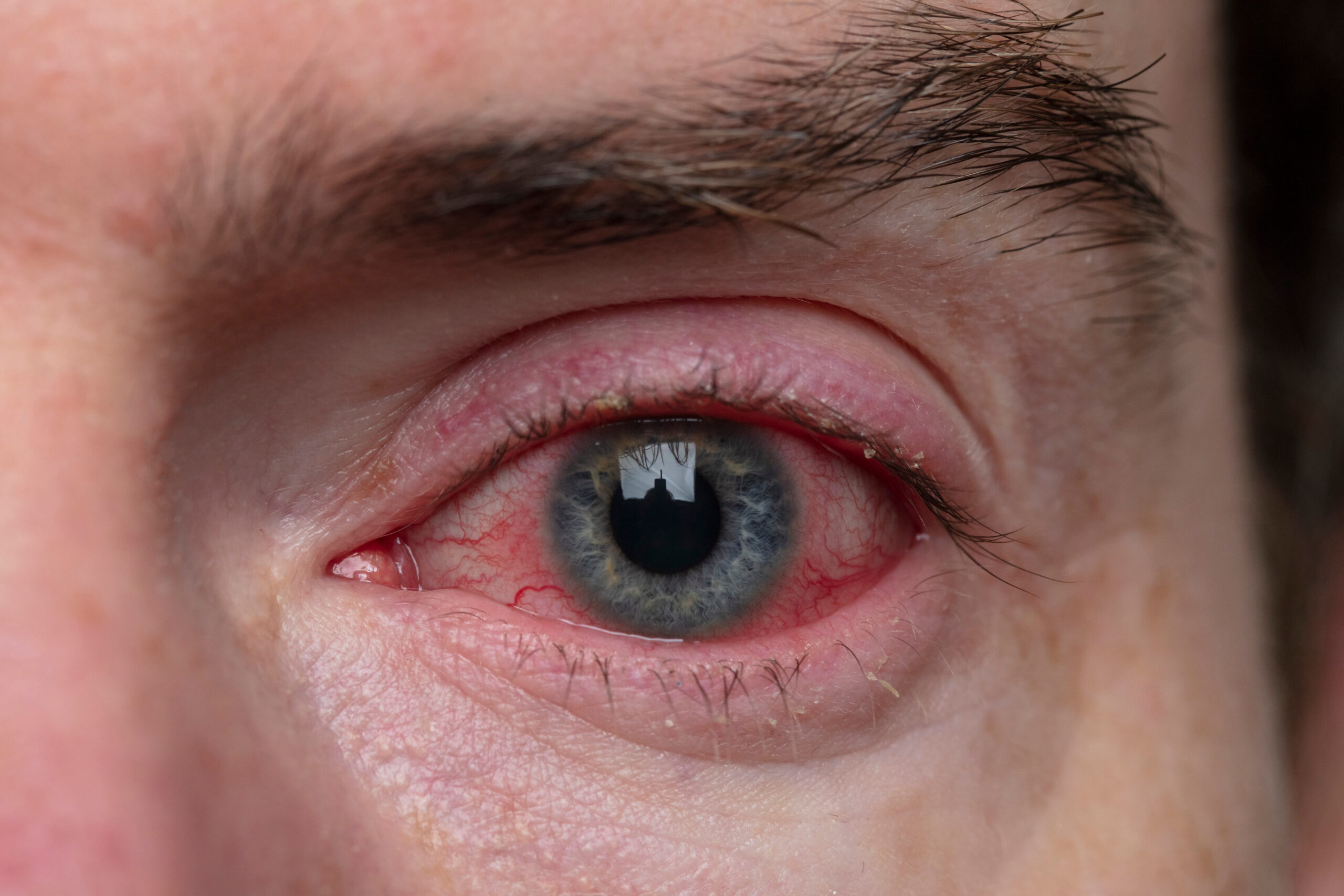 Eye Infection: What Is, Causes, Types, Symptoms, and Diagnosis
