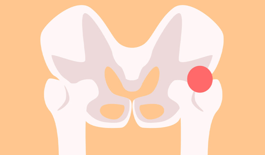 Hip Pain: What Is, Complications, Symptoms, and Treatment