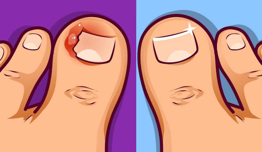 Ingrown Toenail: What Is, Causes, Symptoms, And Prevention