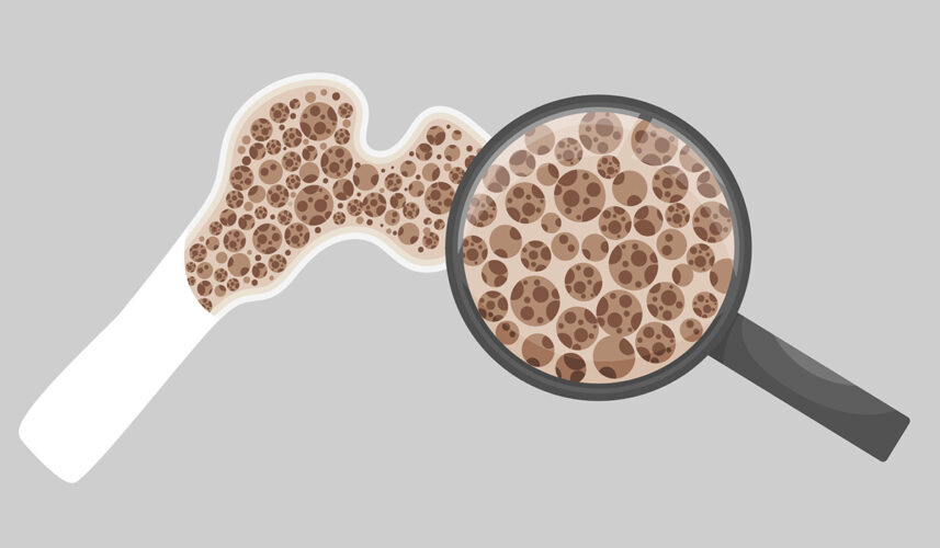 Osteoporosis: What is, Complications, Symptoms, and Treatment