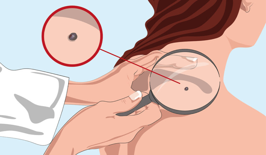 Skin Cancer: What Is, Types, Diagnosis, and Treatment