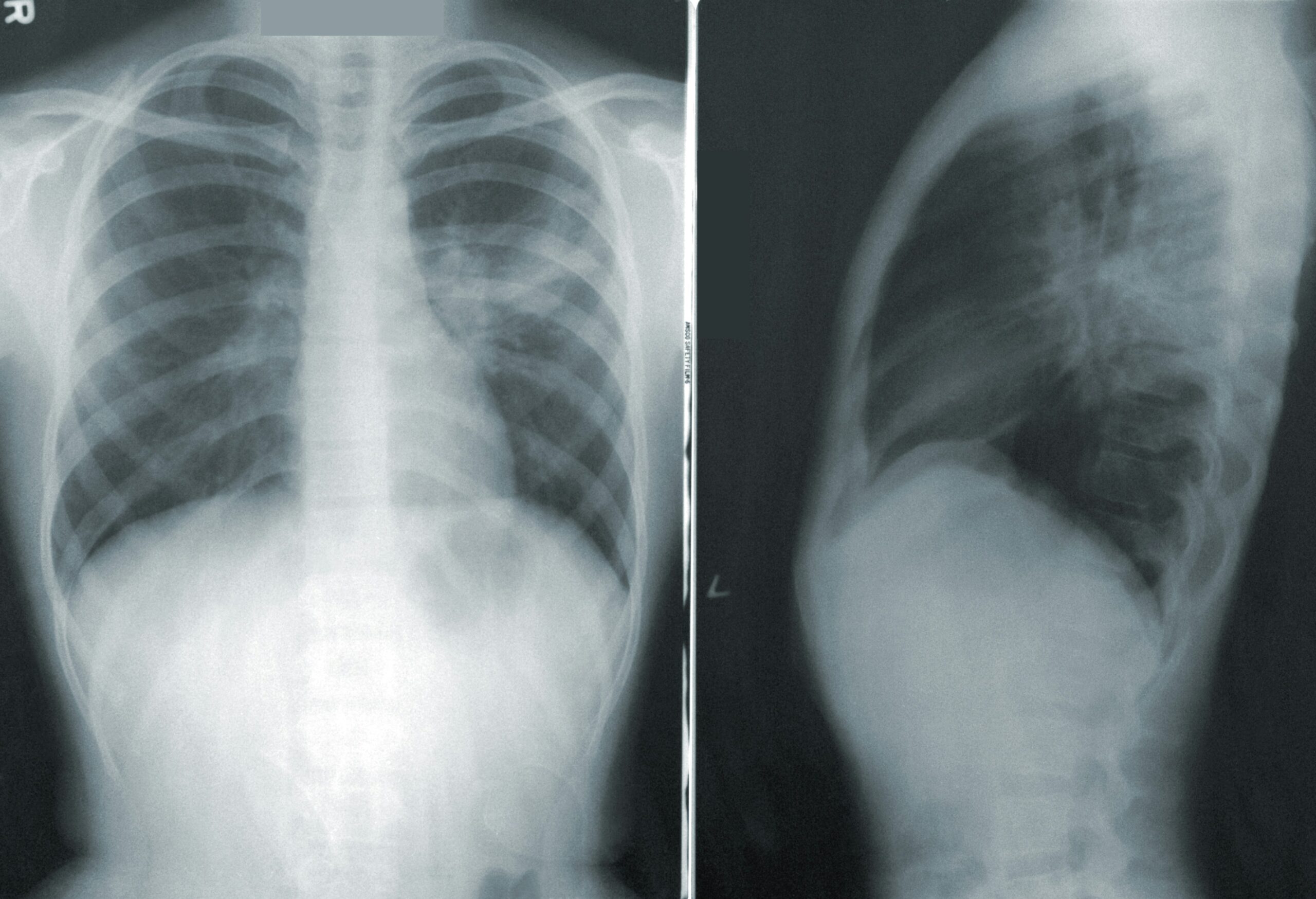 X-Ray: What Is, History, Uses, Procedure, Contrasting and Risk