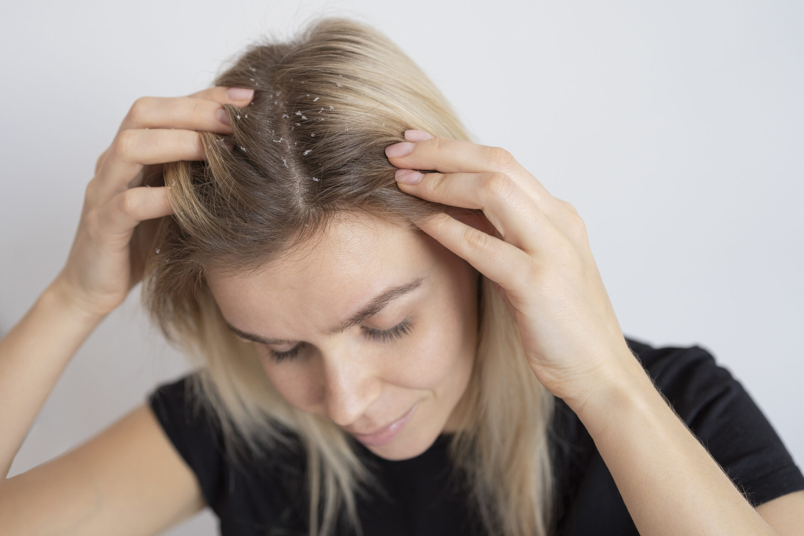 Dry Scalp: What Is, Symptoms, Causes, and Treatment