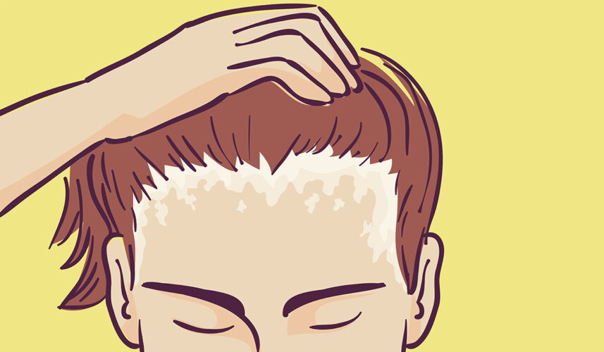 Dry Scalp: What Is, Symptoms, Causes, and Treatment