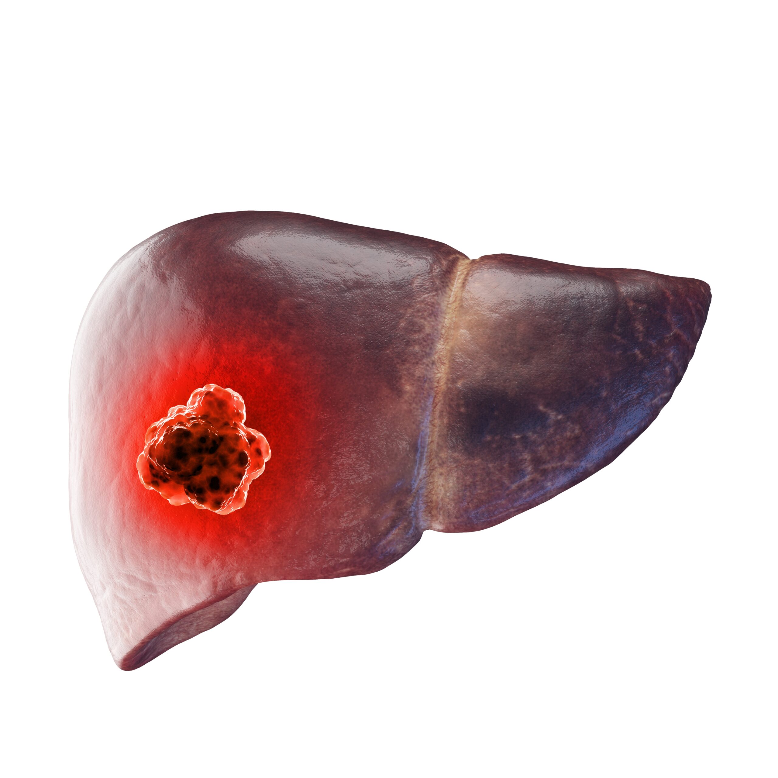 Liver Cancer: What Is, Causes, Symptoms, Diagnosis, and Prevention