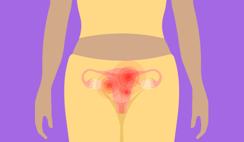 Pelvic Inflammatory Disease (PID): What Is, Causes, and Symptoms