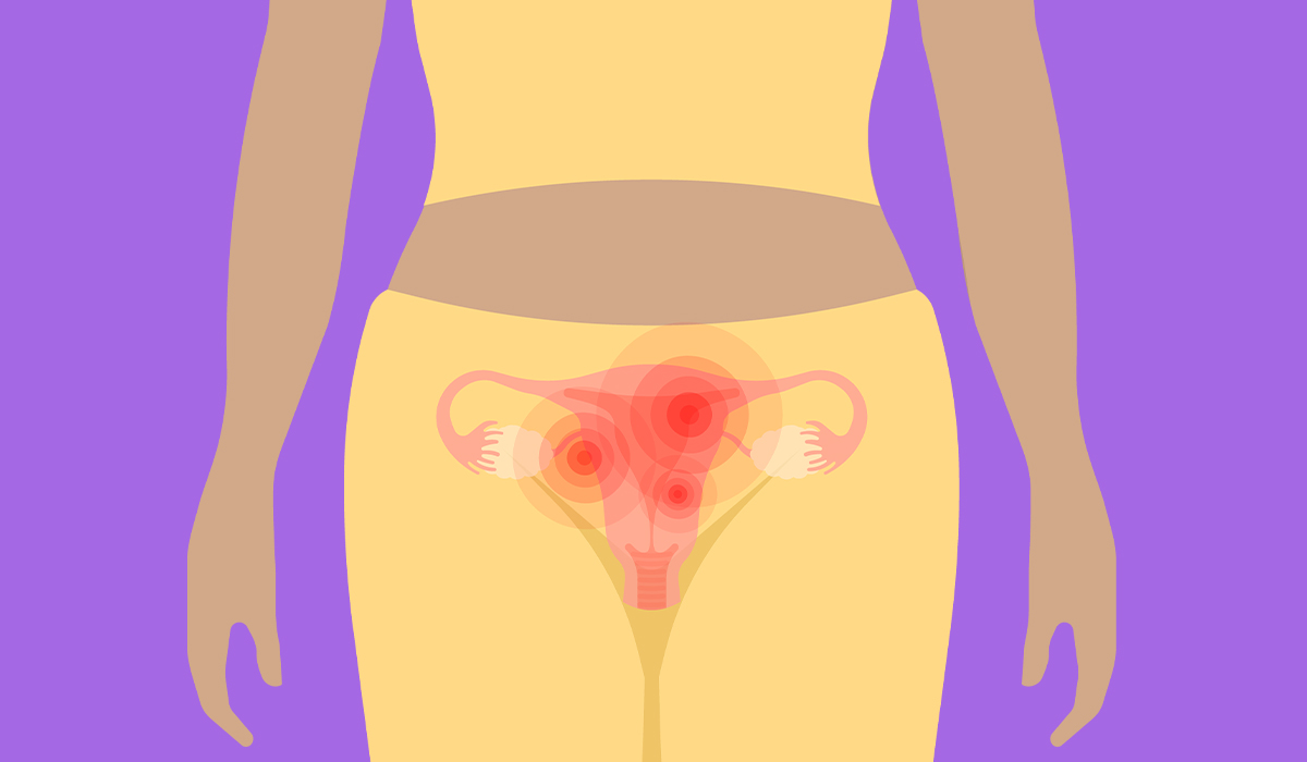 Pelvic Inflammatory Disease