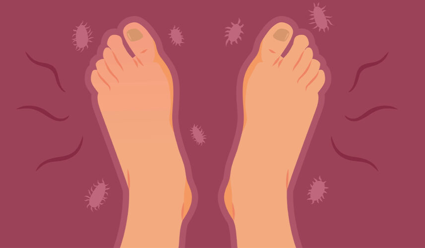 Toenail Fungus: What Is, Causes, Treatment, and Prevention