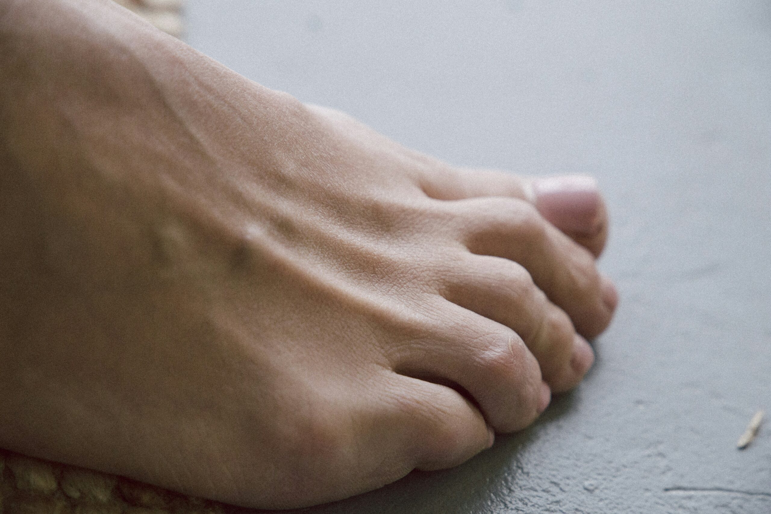 Toenail Fungus: What Is, Causes, Treatment, and Prevention