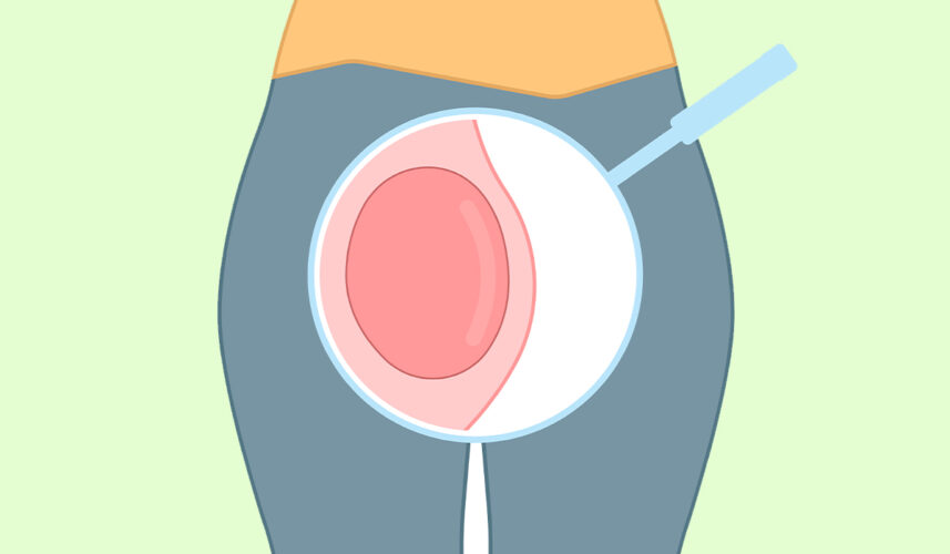 Bartholin Cyst: What Is, Signs, Diagnosis, and Treatment