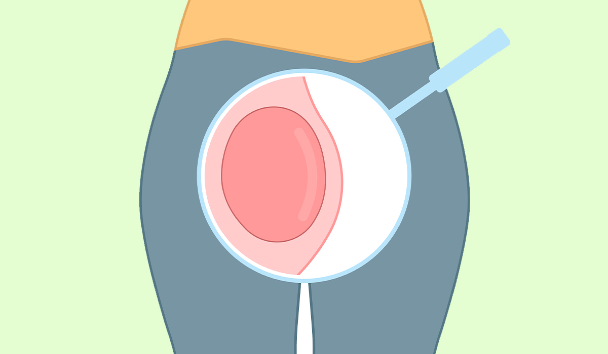 Bartholin Cyst