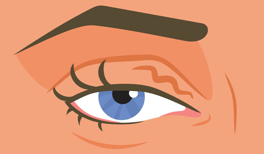 Eye Twitching: What Is, Signs, Complications, and Treatment